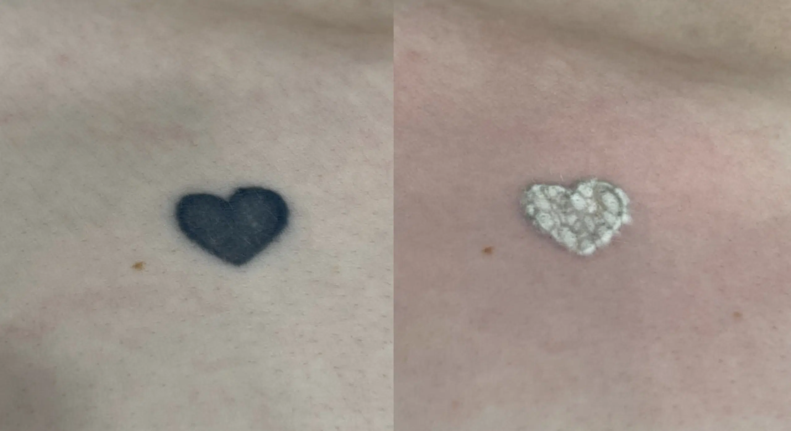 detatouage-apres-1-seance