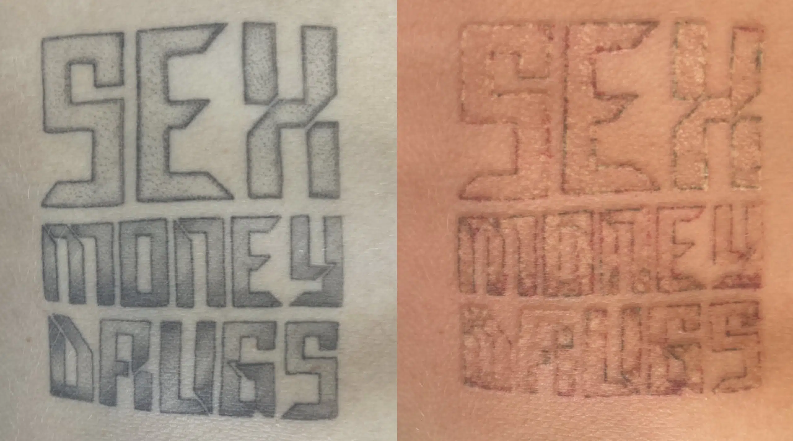 detatouage-avant-apres