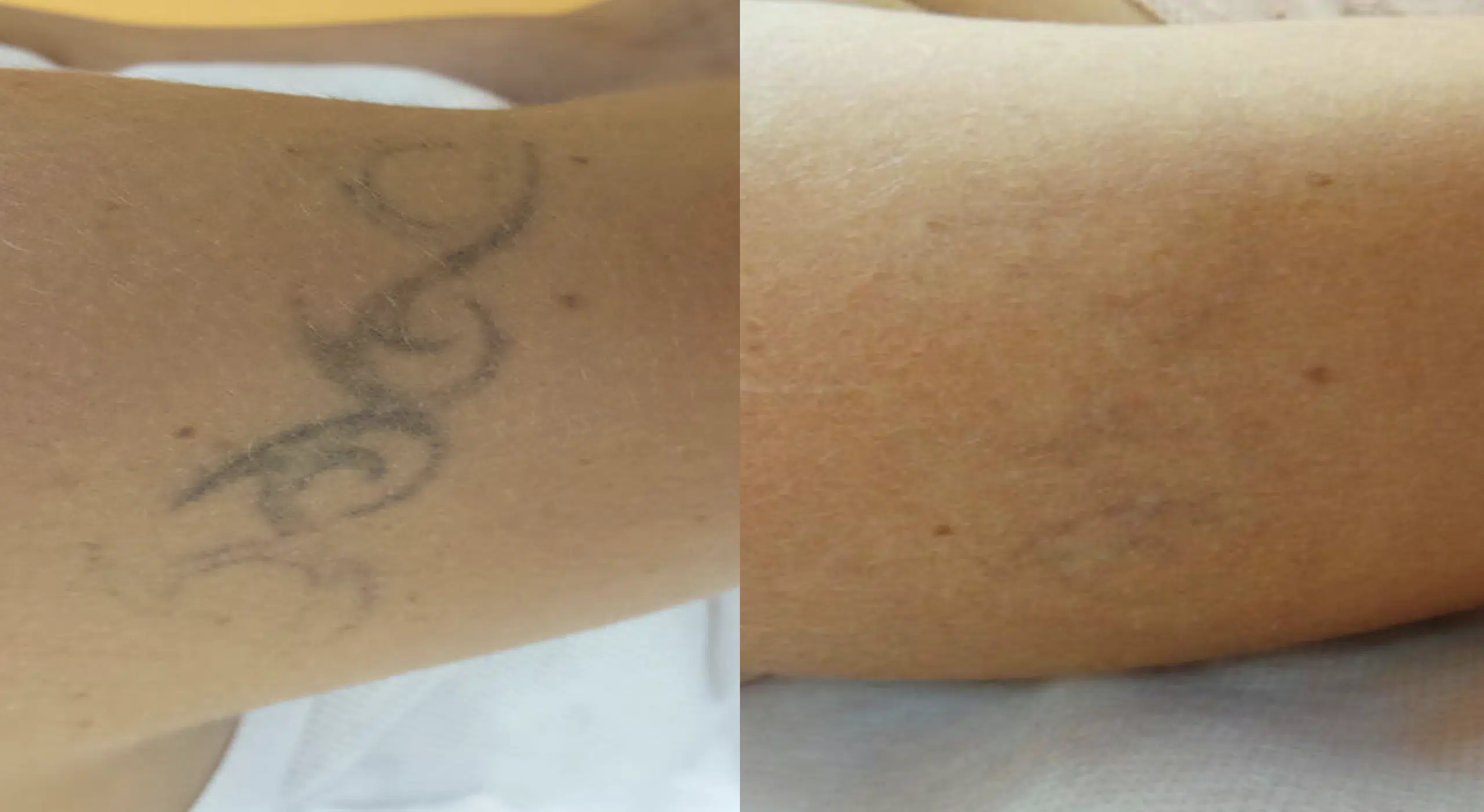 detatouage-avant-apres