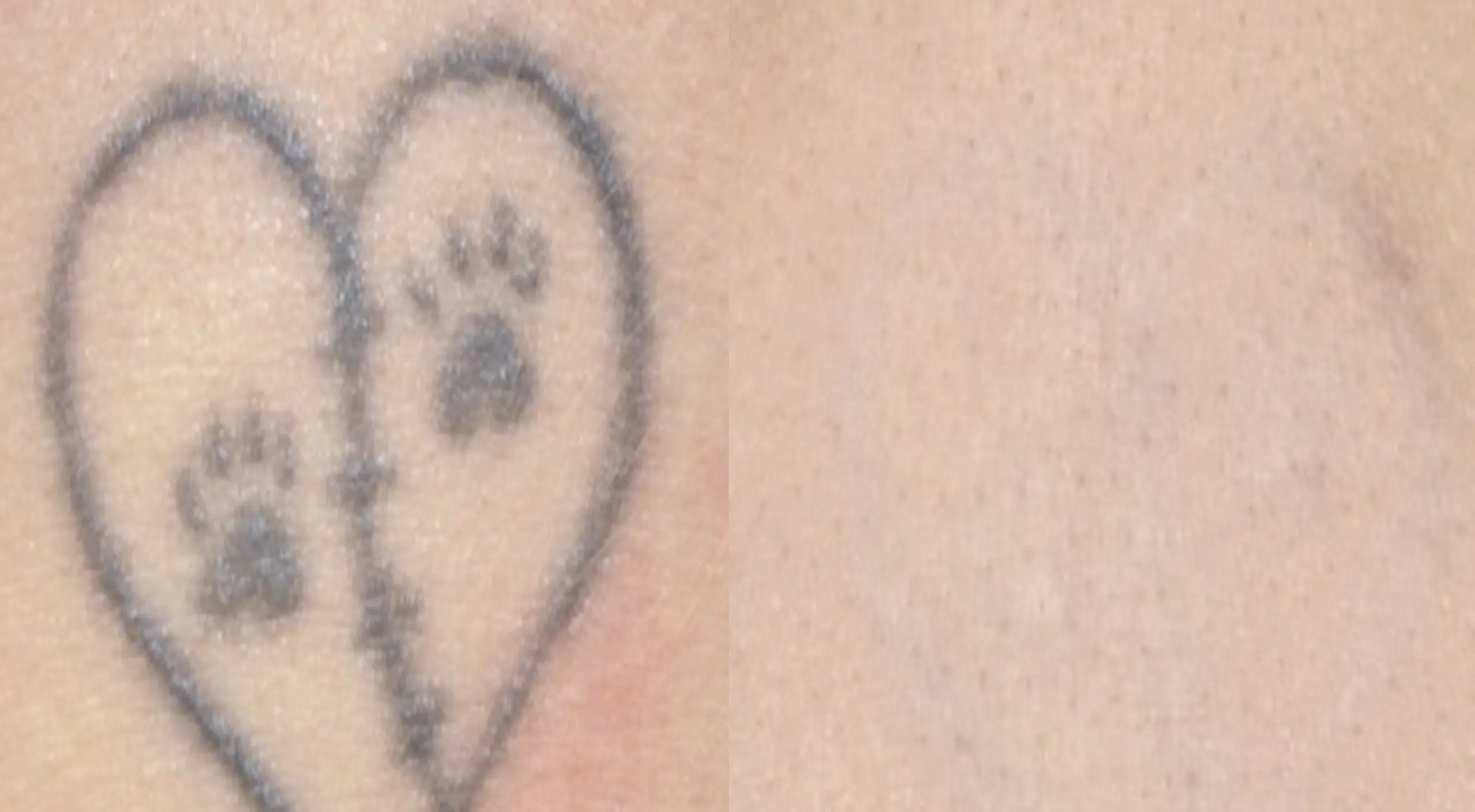 detatouage-avant-apres