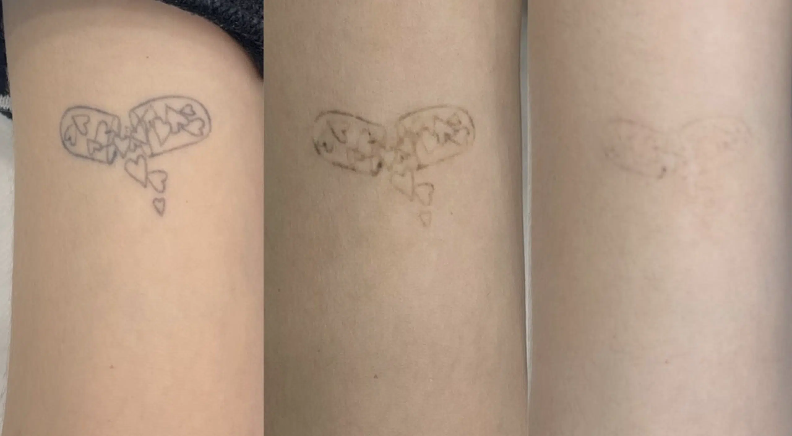 detatouage-avant-apres