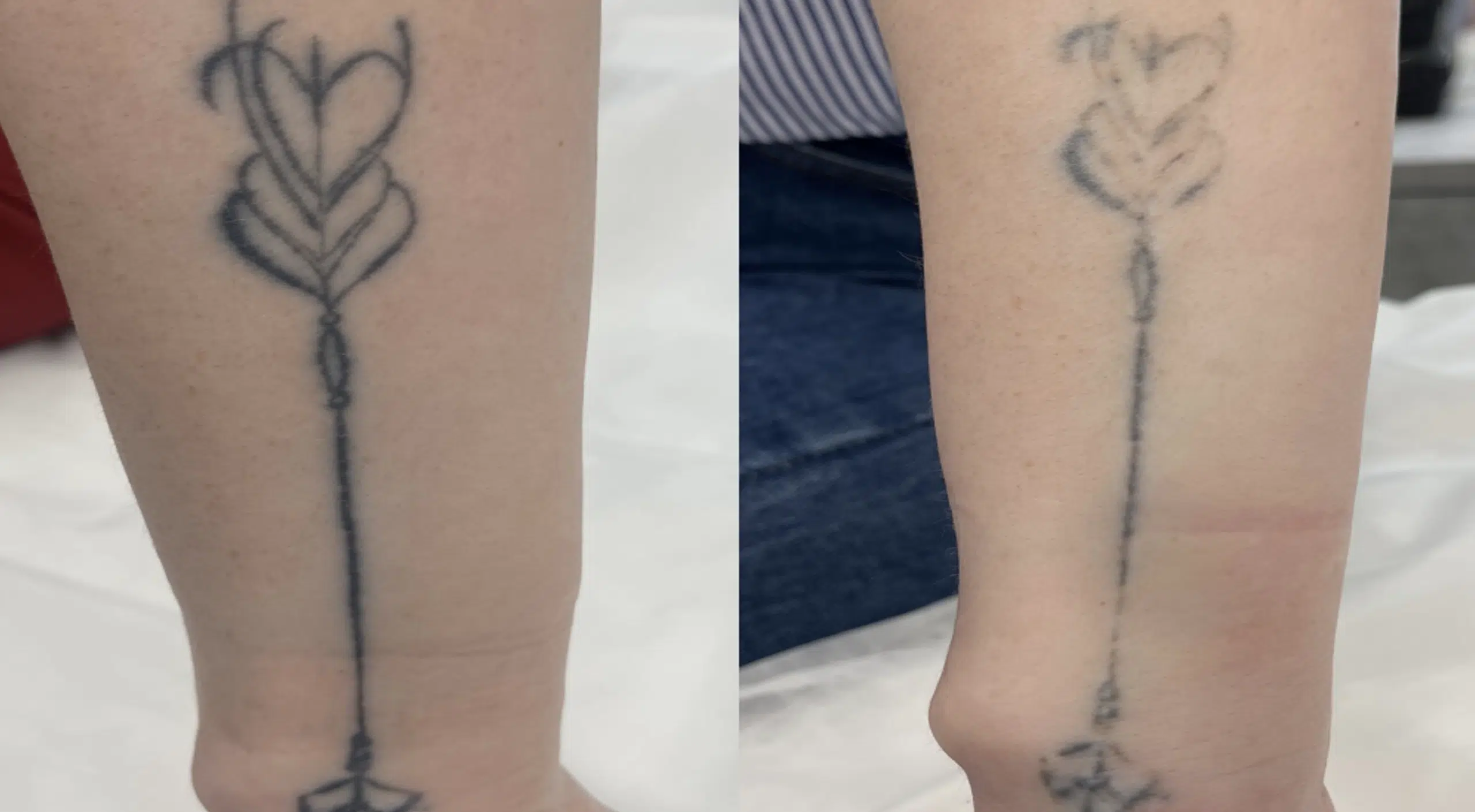 detatouage-avant-apres