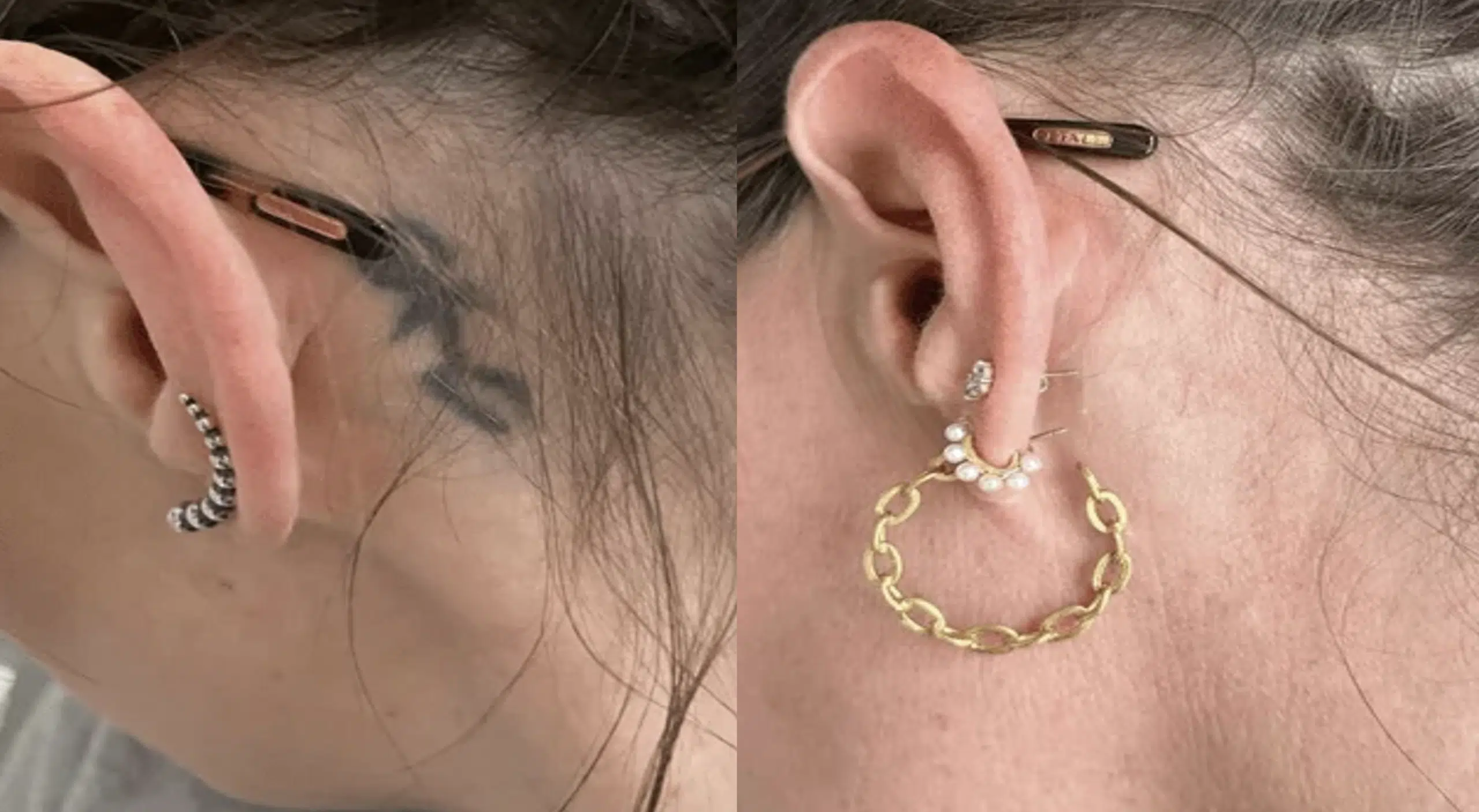 detatouage-avant-apres