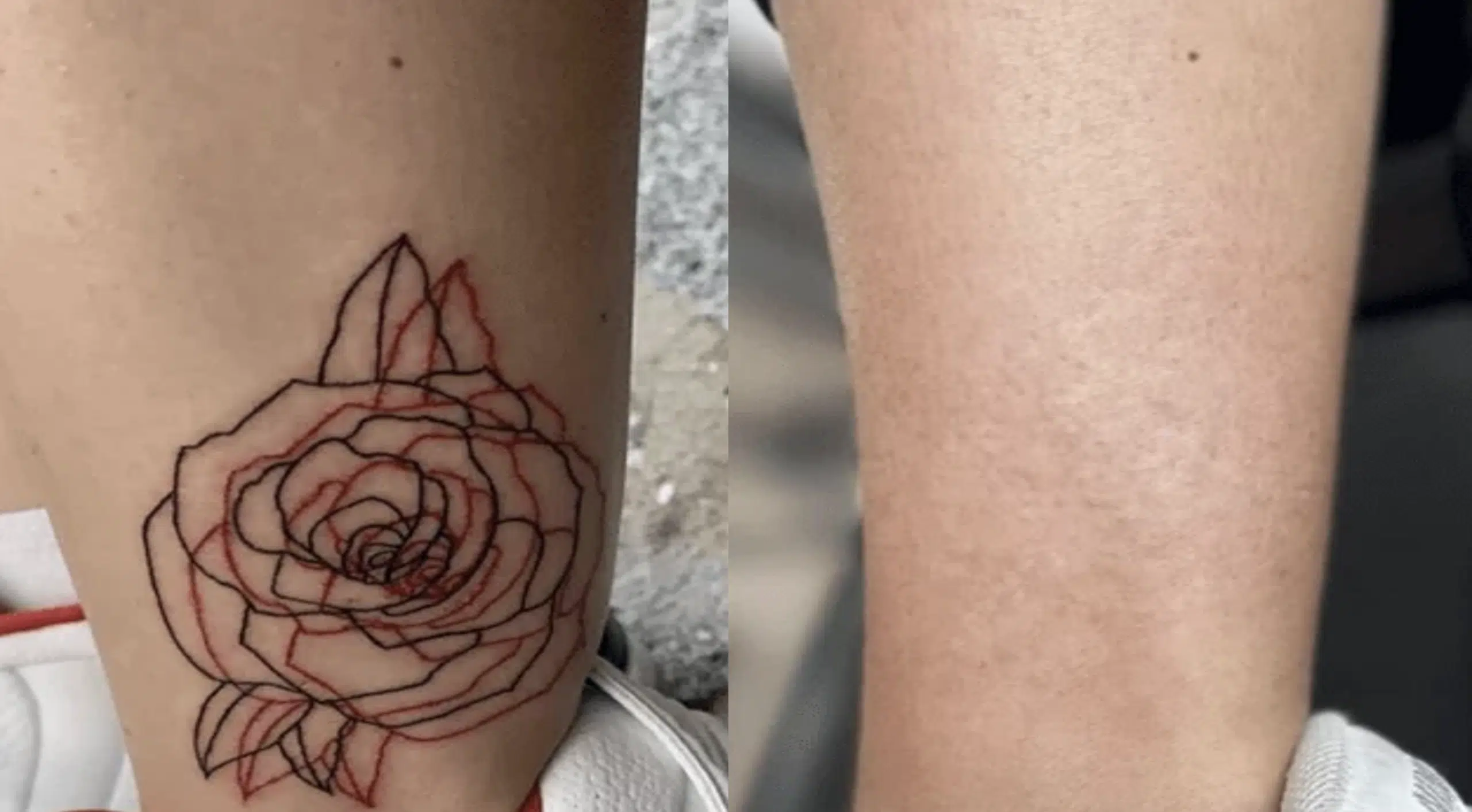 detatouage-avant-apres