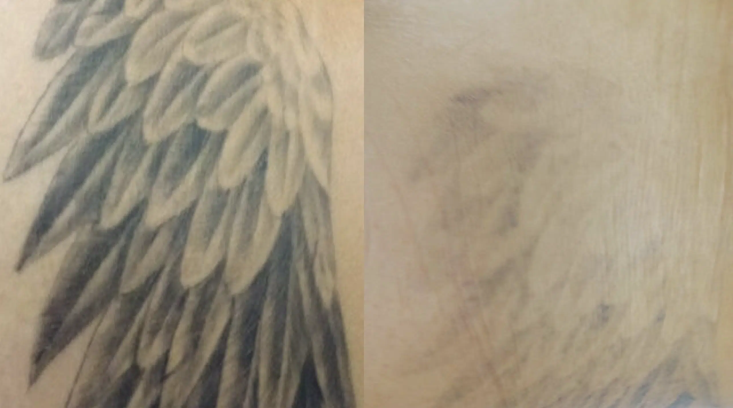 detatouage-avant-apres