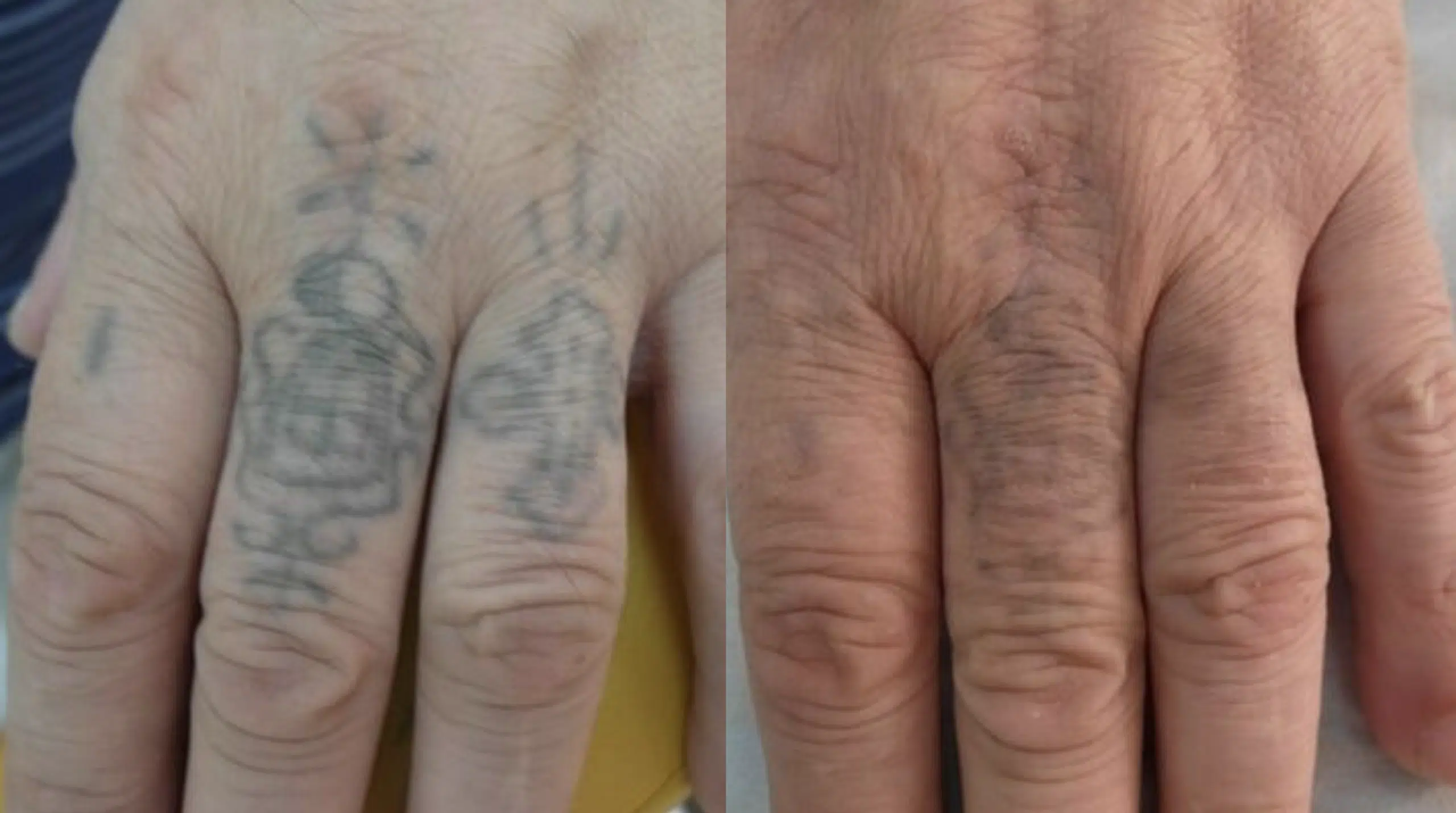 detatouage-avant-apres