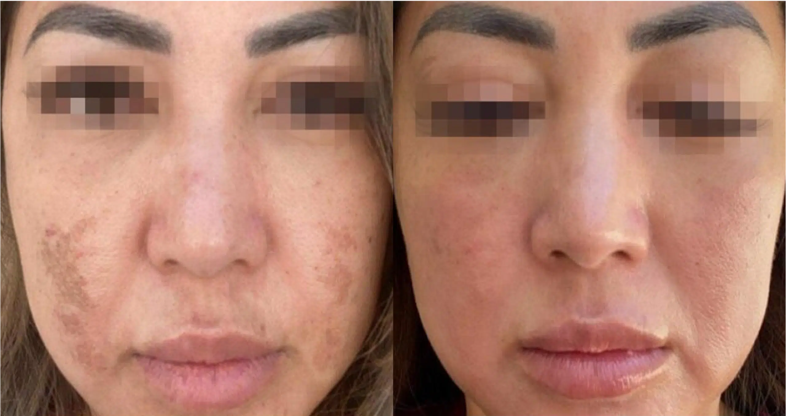 laser tache brunes avant après