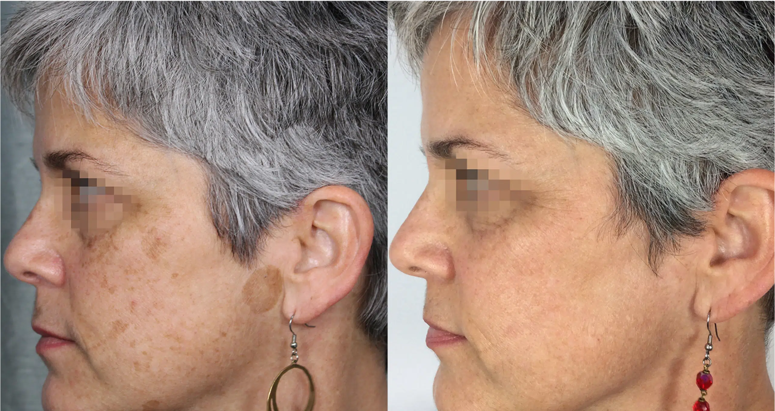 laser tache brunes avant après