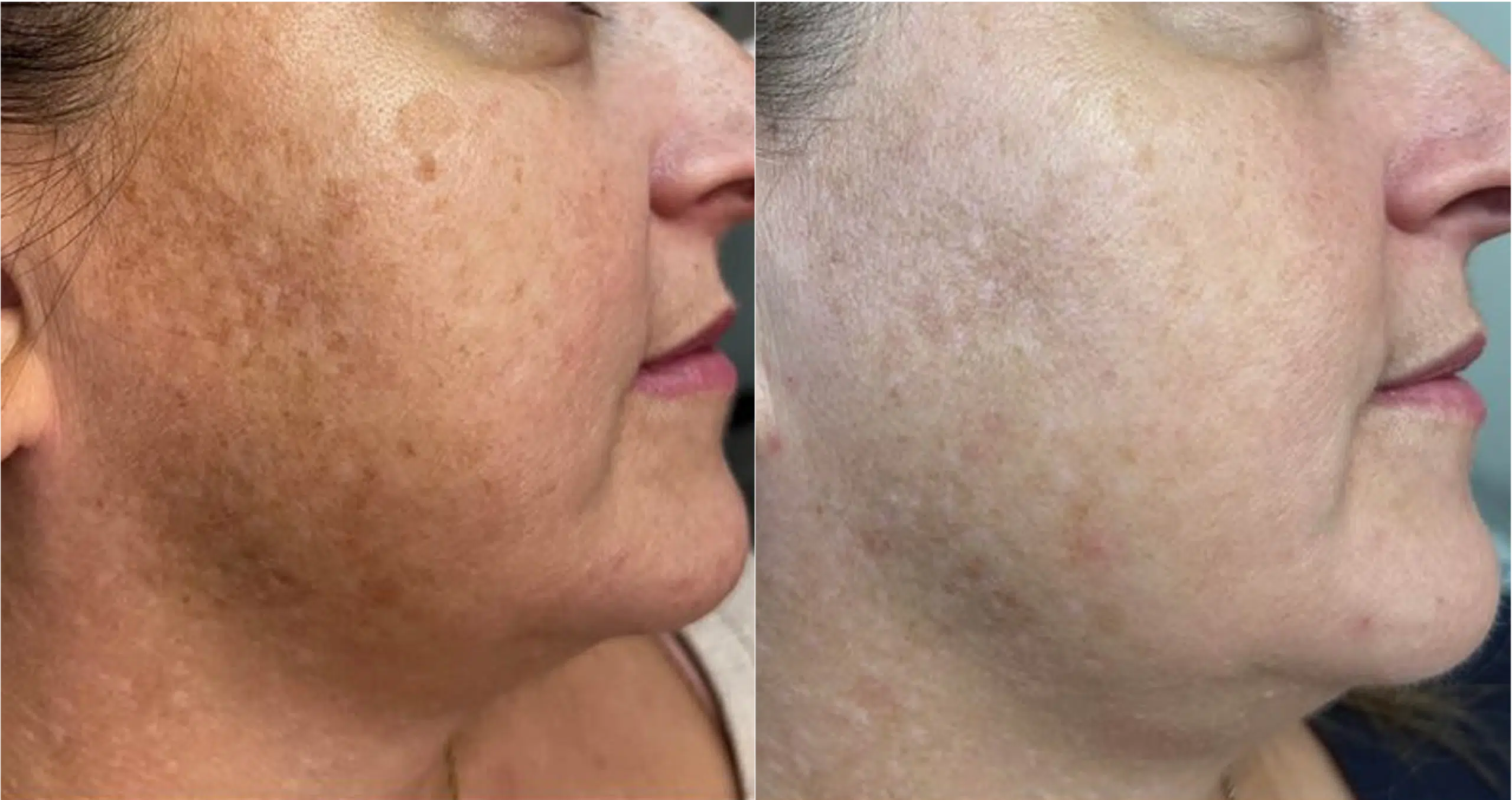 laser tache brunes avant après