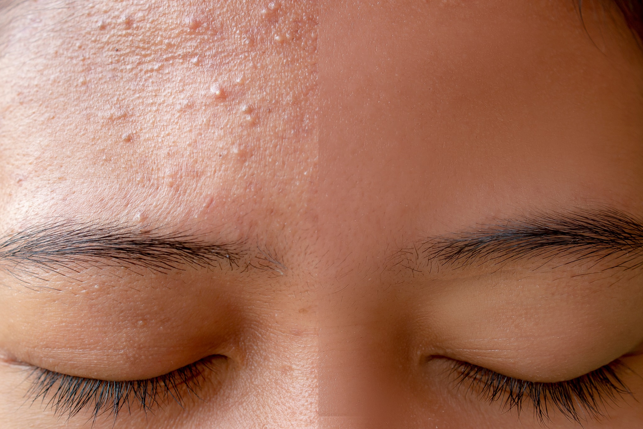 Acne-fongique-dermatologue