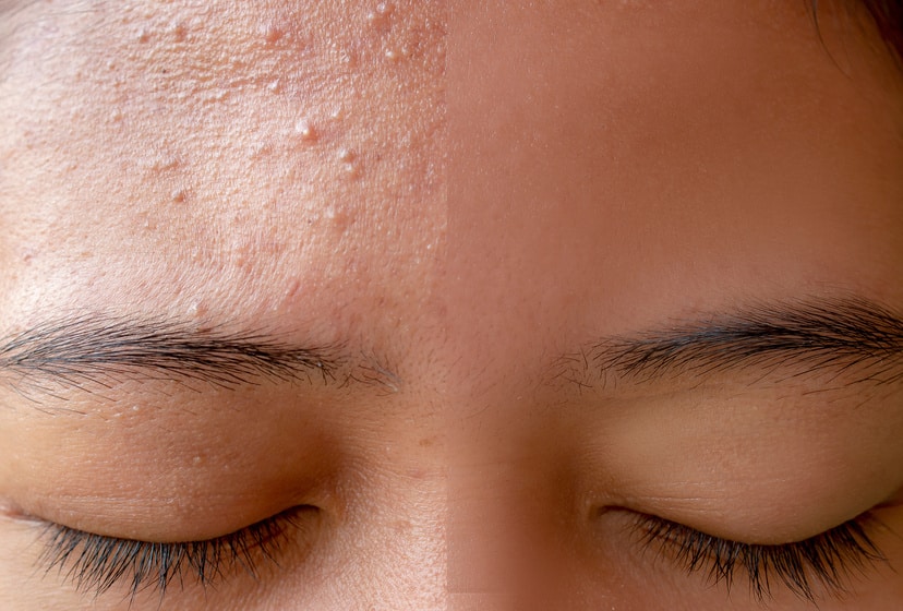 Acne-fongique-skin-marceau