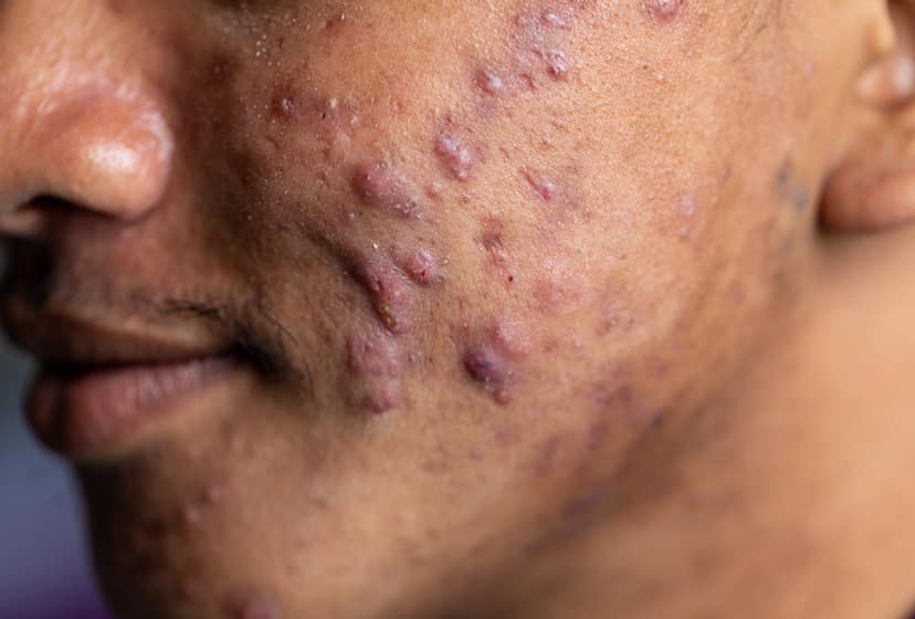 Acne-kystique-dermatologue