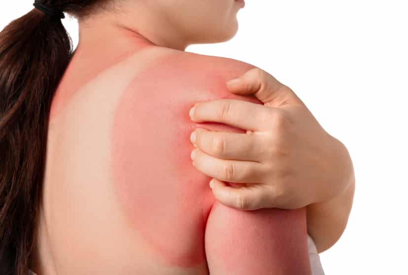 soleil-risque-cancer-peau-dermatologue