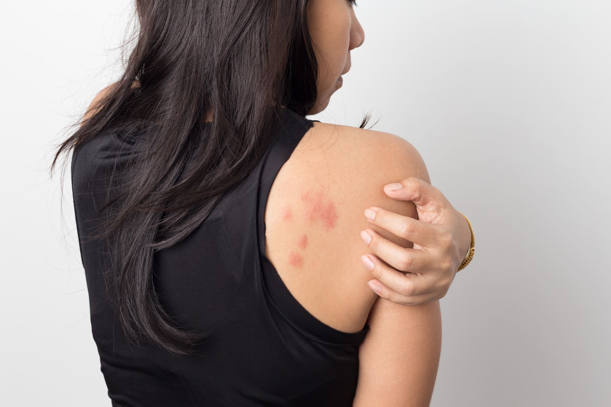urticaire-chronique-causes-traitements-dermatologue