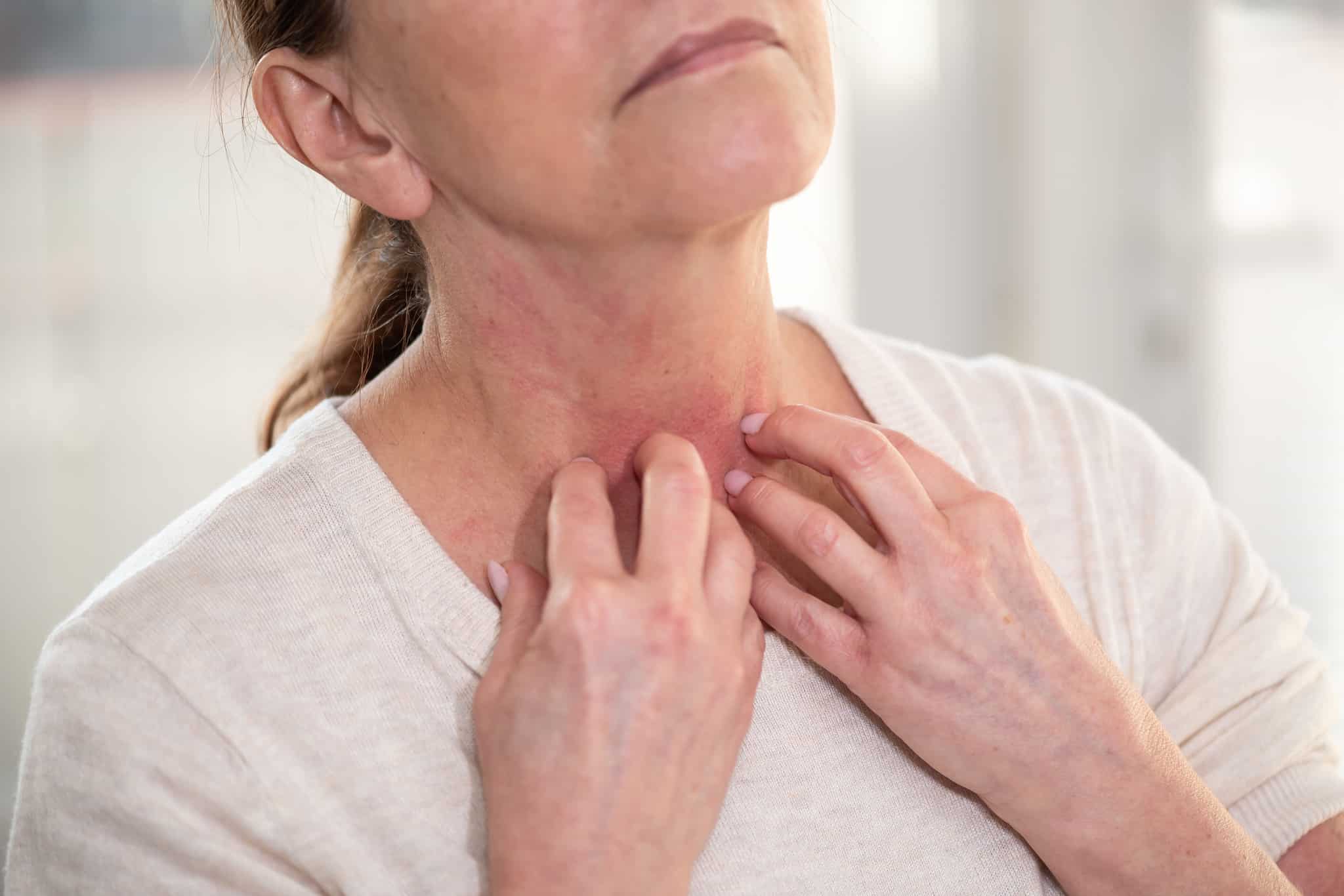 vivre-avec-eczema