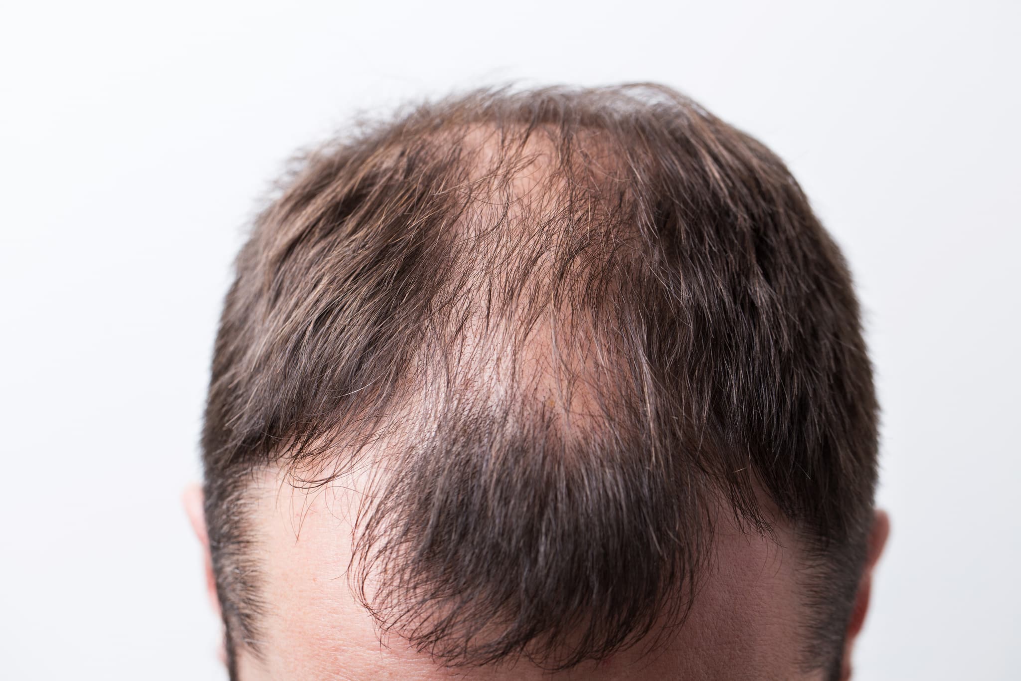 PERTE-CHEVEUX-CAUSE