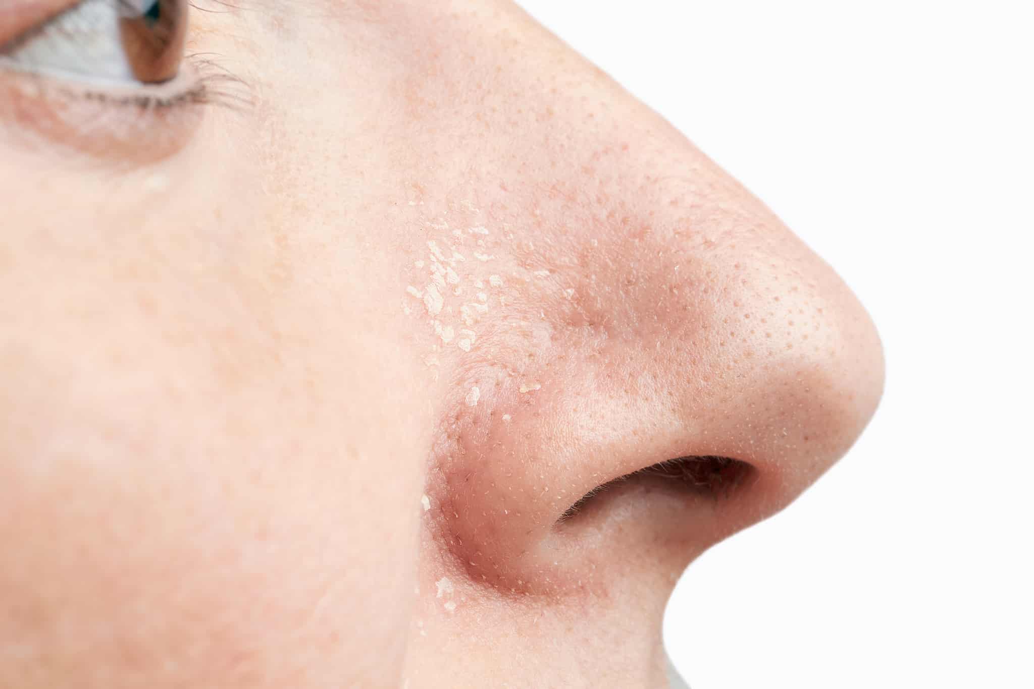 hydrater-peau-seche