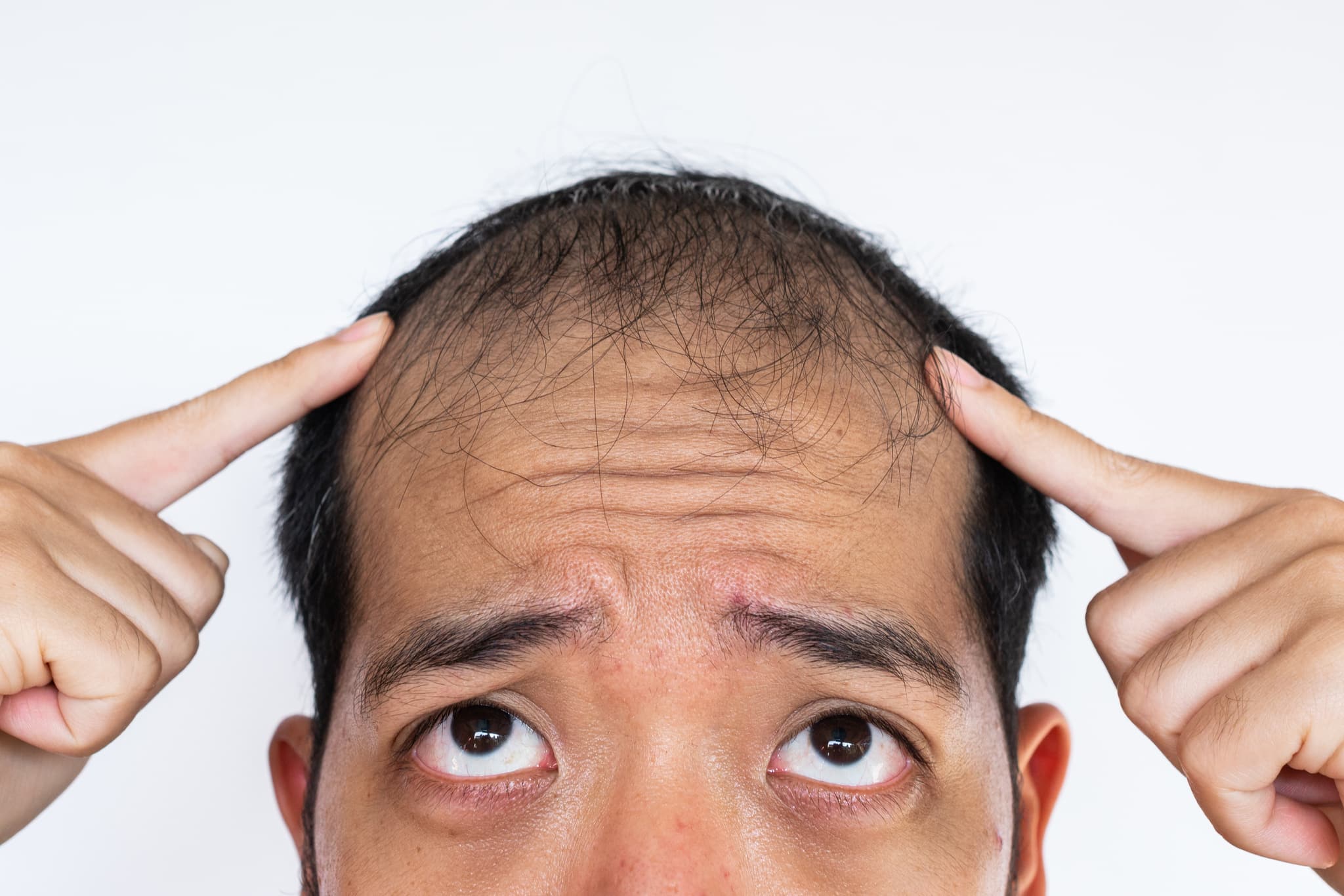 minoxidil-cheveux