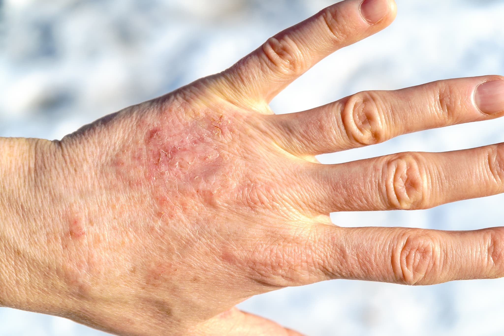 psoriasis-et-arthrite