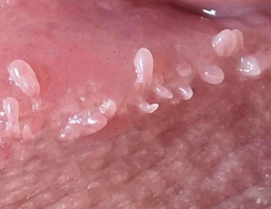 condylome femme vulvaire photo