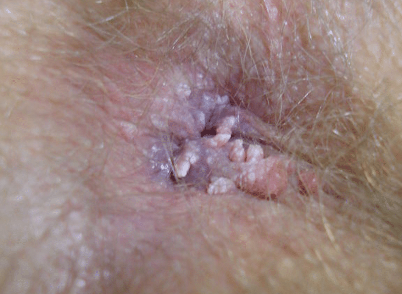 condylome anus photo anale
