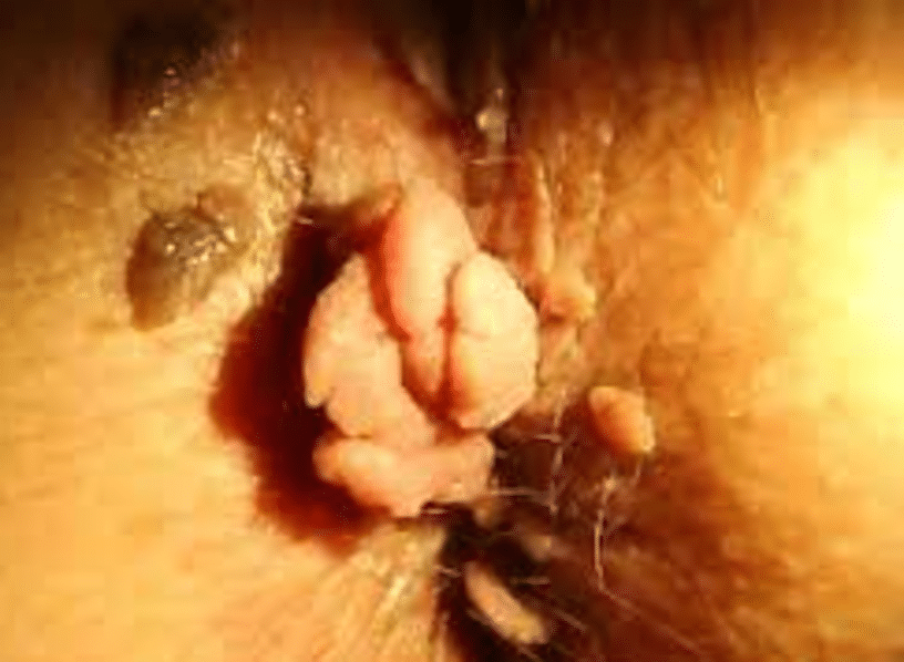 condylome anus photo anale