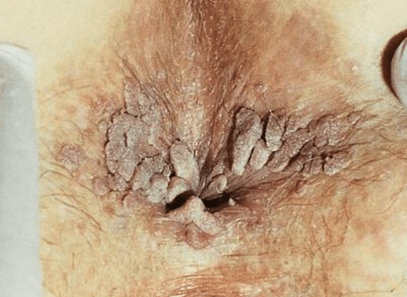 condylome anus photo anale