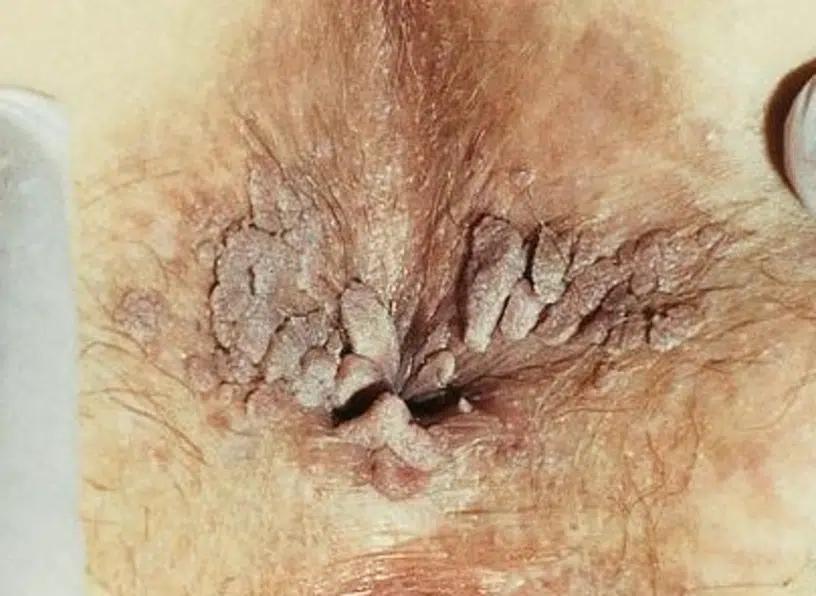 condylome anus photo anale