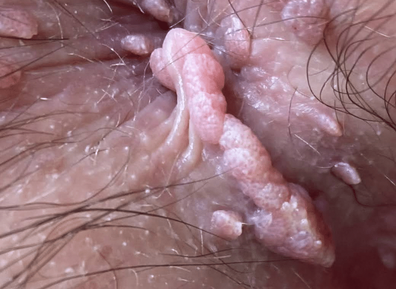 condylome anus photo anale