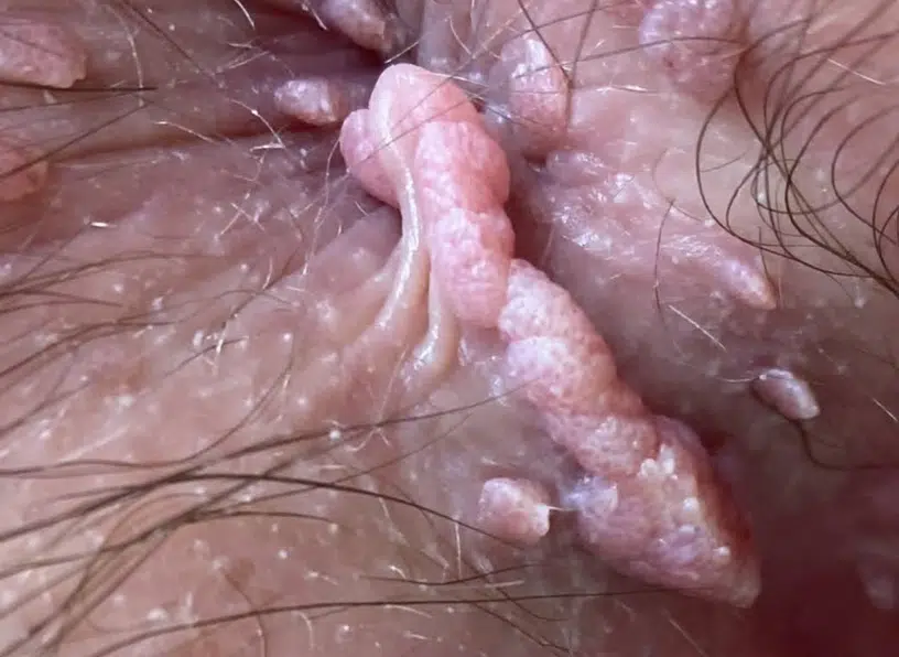 condylome anus photo anale