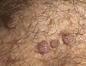 condylome homme photos 1