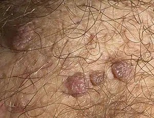 condylome homme photos 1