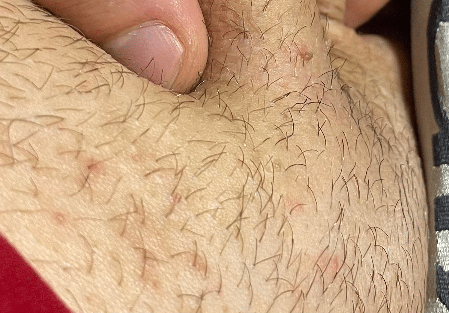 condylome homme photos 1