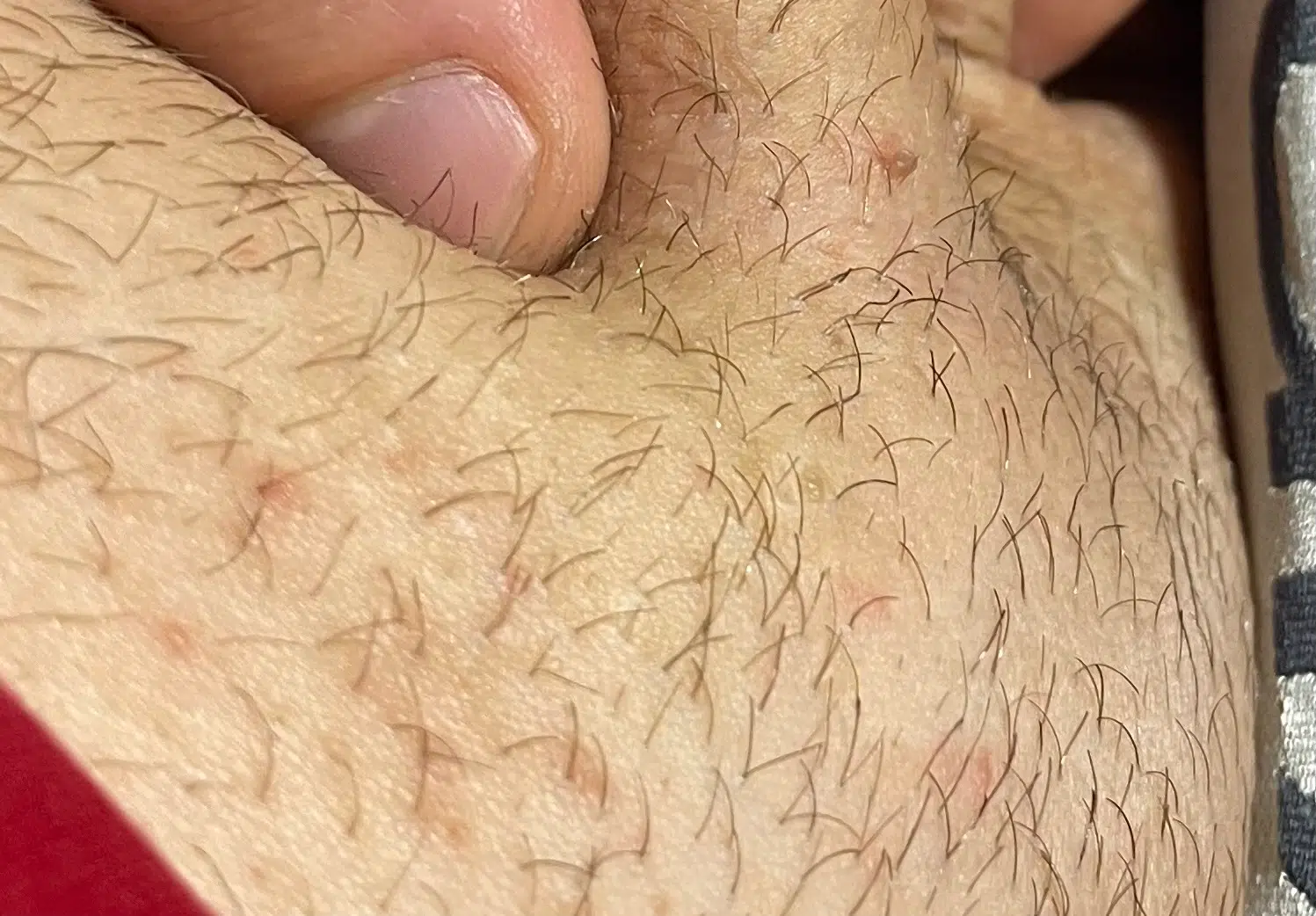 condylome homme photos 1