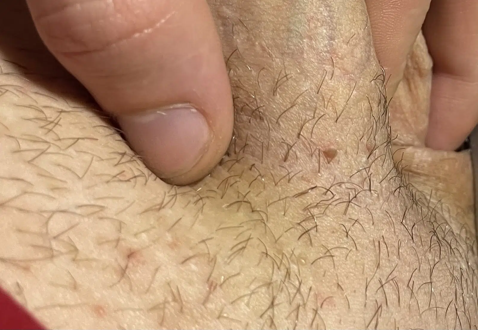 condylome homme photos 1