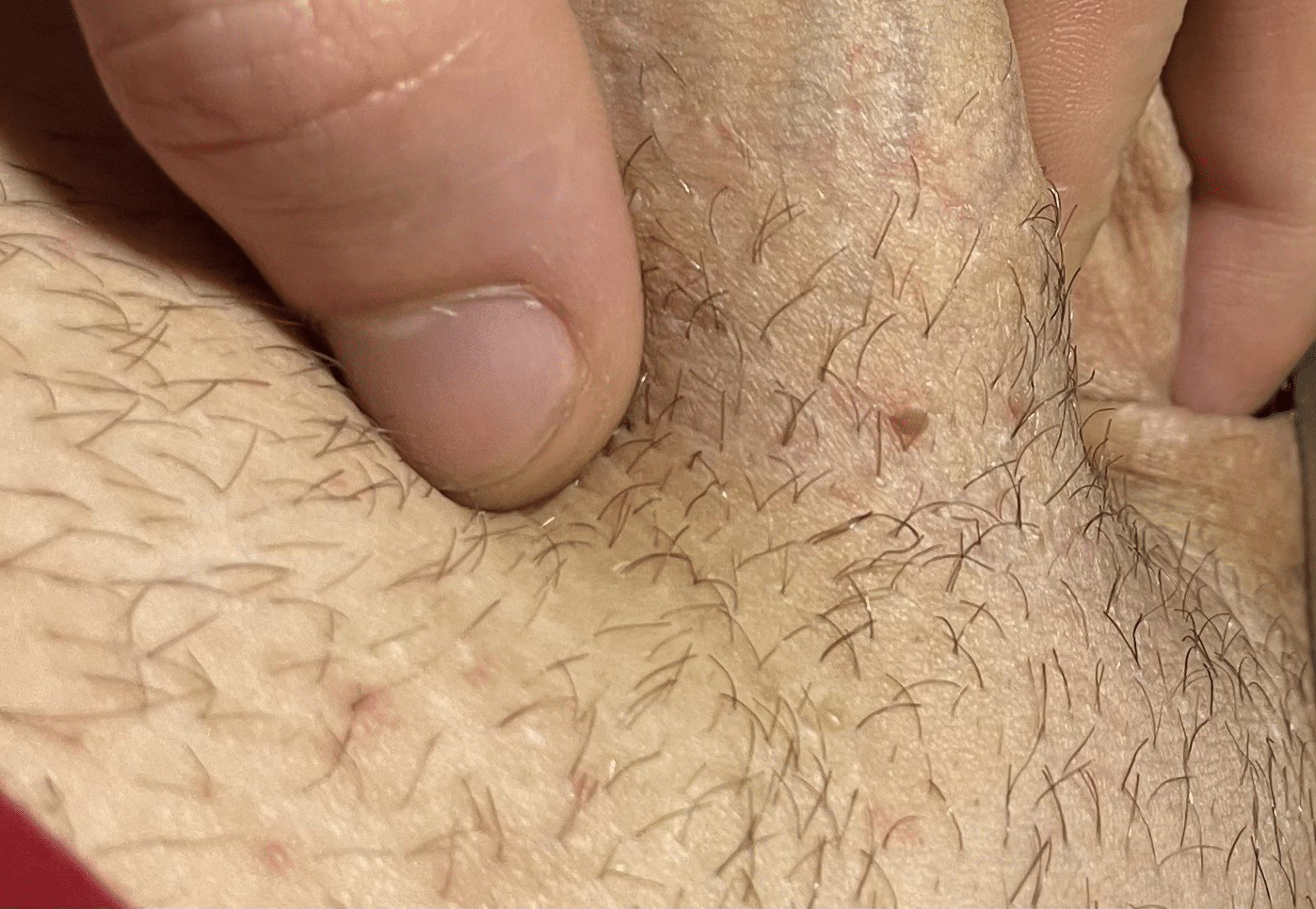 condylome homme photos 1