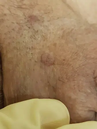 condylome homme photos 1