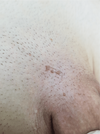condylome homme photos 1