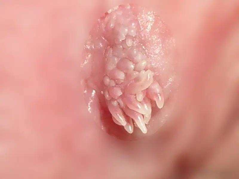 condylome femme vulvaire photo