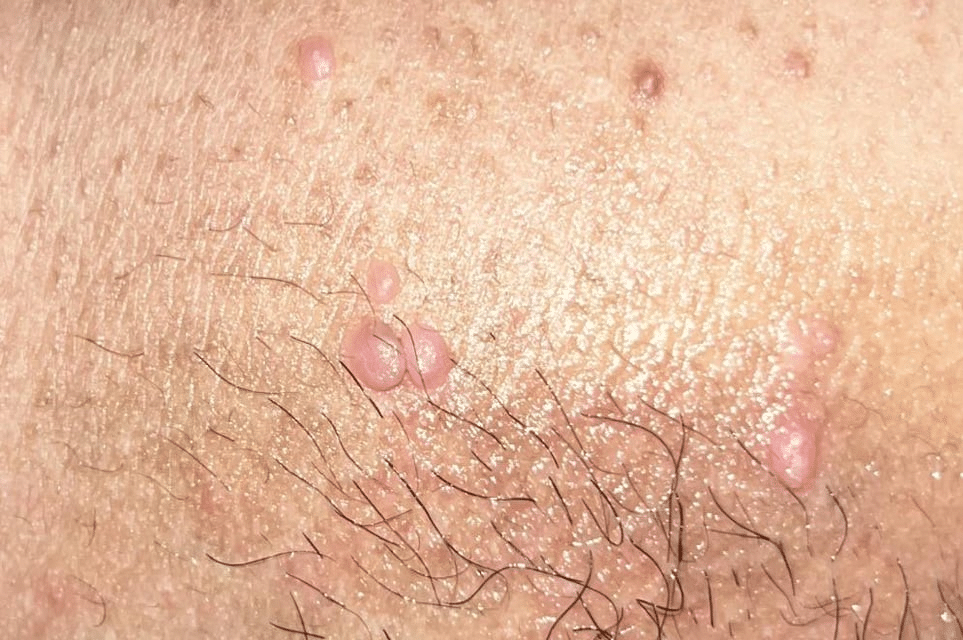 condylome femme vulvaire photo