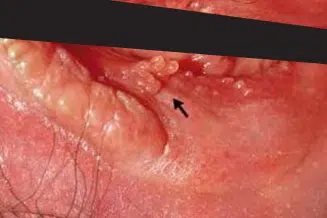 condylome femme vulvaire photo