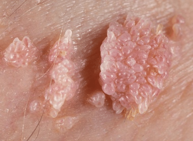 verrues peniennes photo