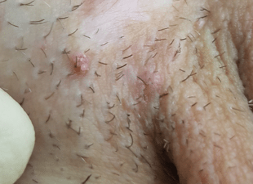 verrues peniennes photo