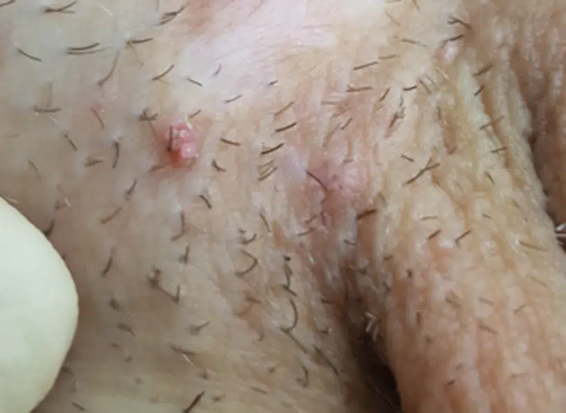 verrues peniennes photo