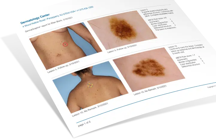 dermatoscopie IA dépistage cancer de la peau Skin Marceau 2