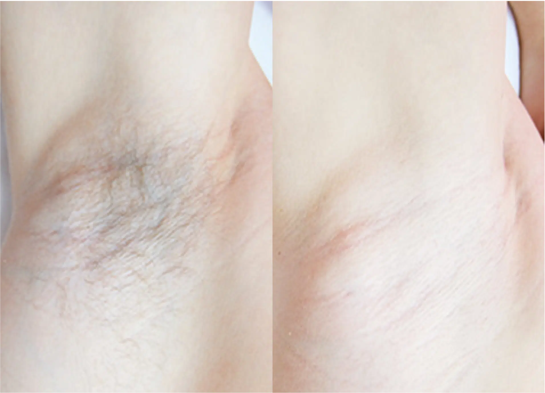 épilation laser aisselles avant après