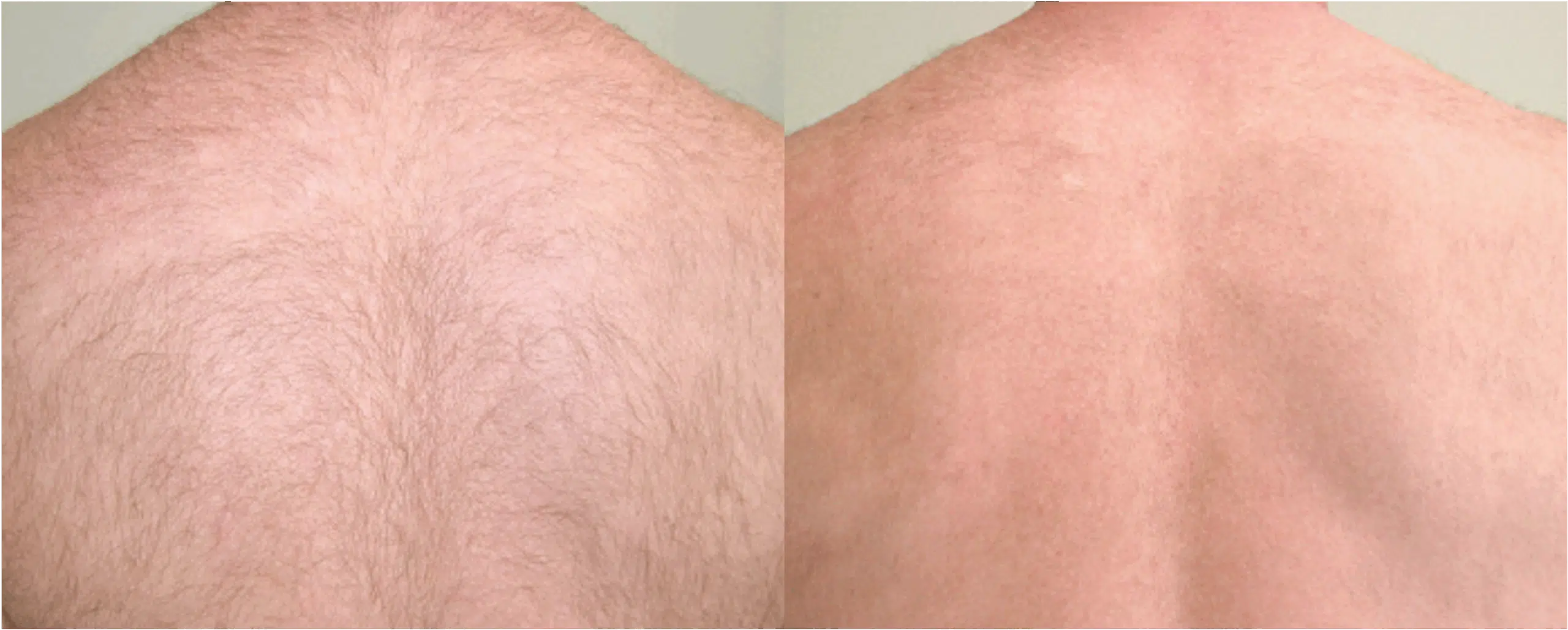 épilation laser dos avant après