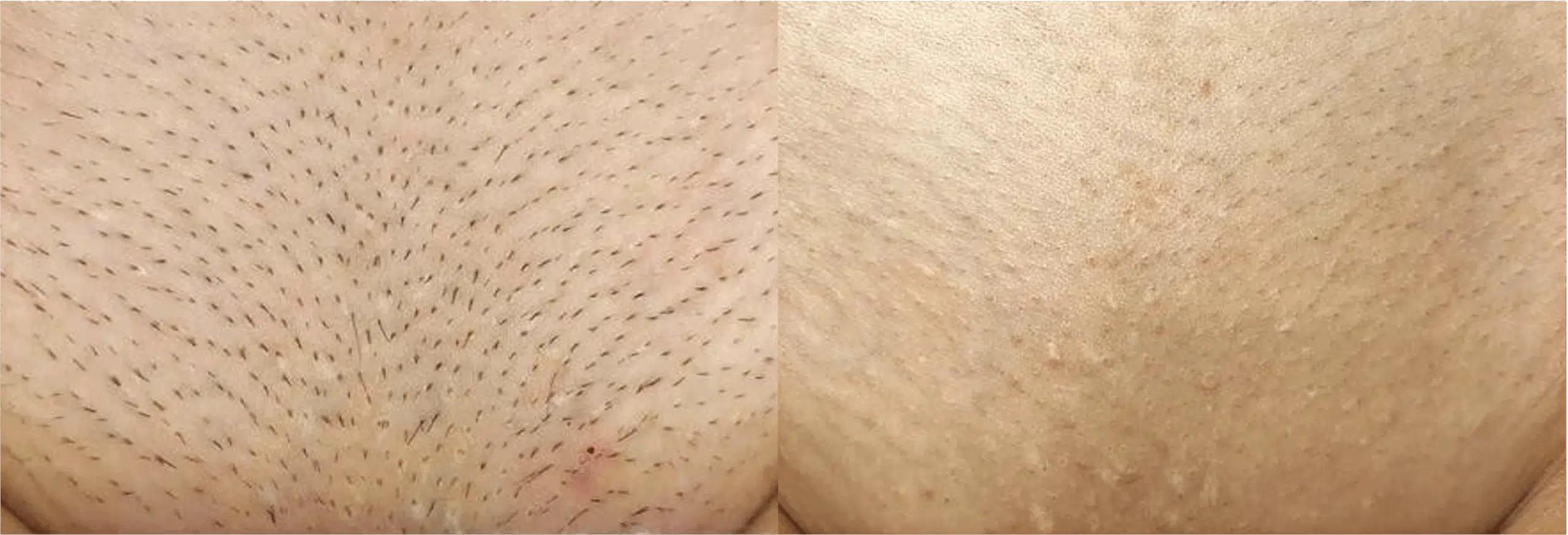 épilation laser maillot intégrale avant après