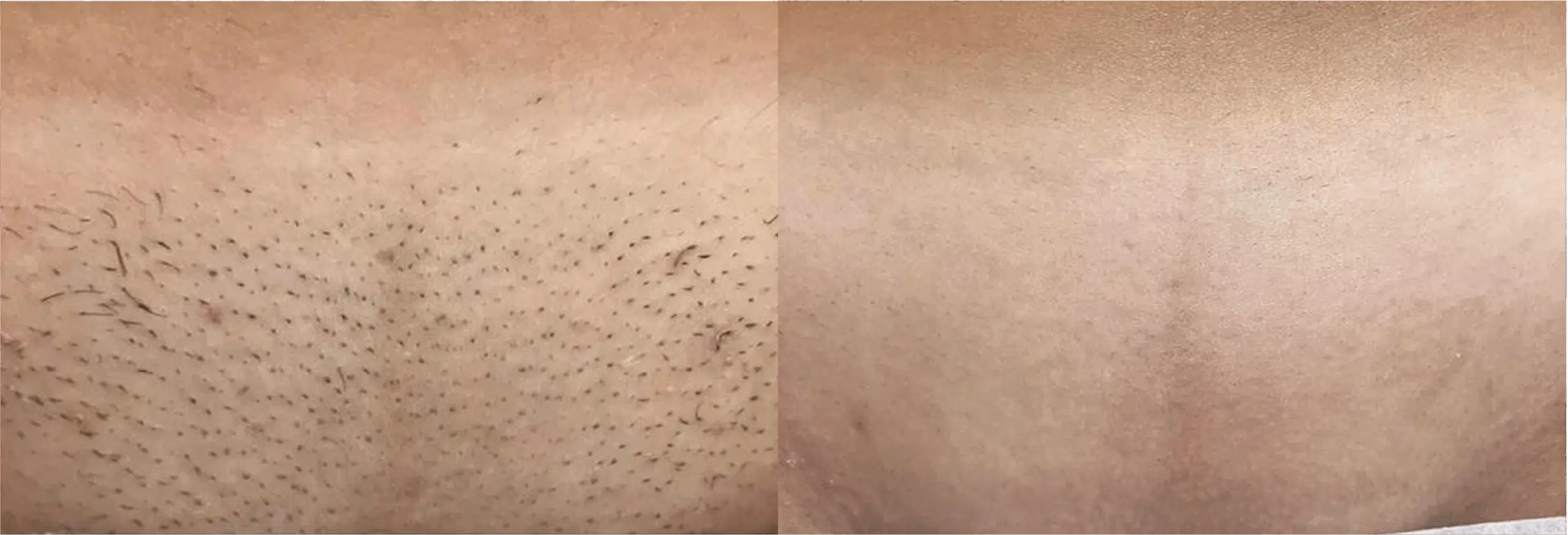 épilation maillot intégrale laser avant après