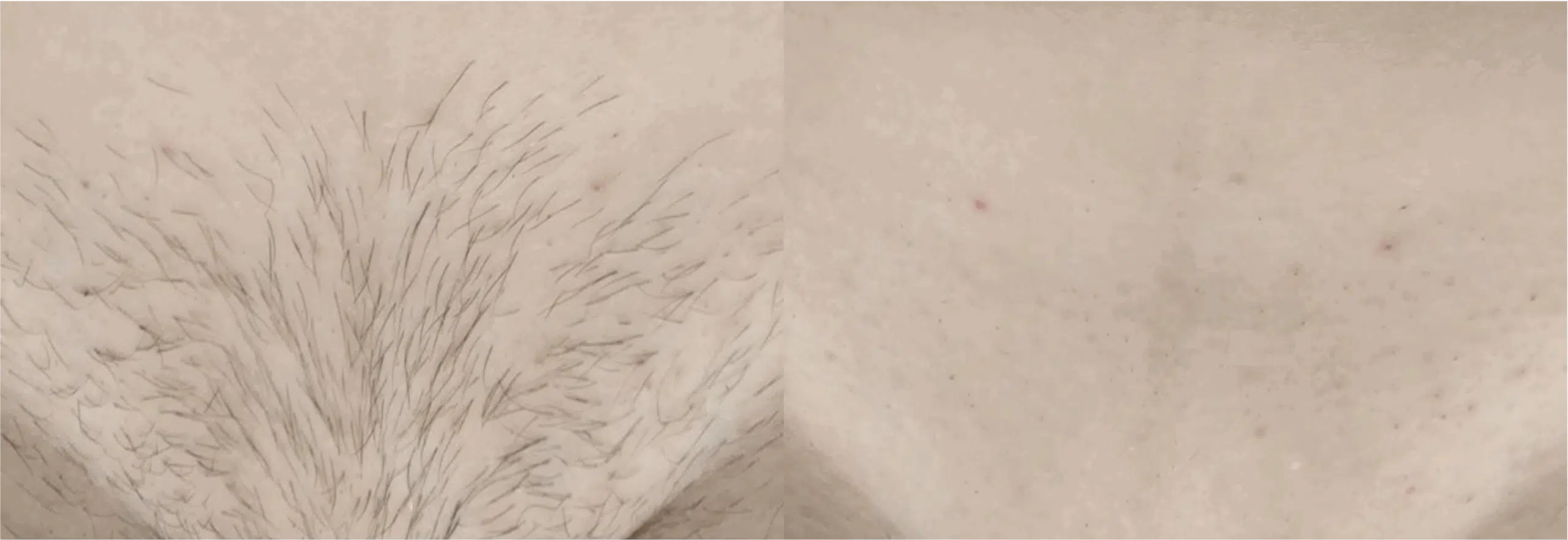 épilation maillot intégrale avant après laser 2